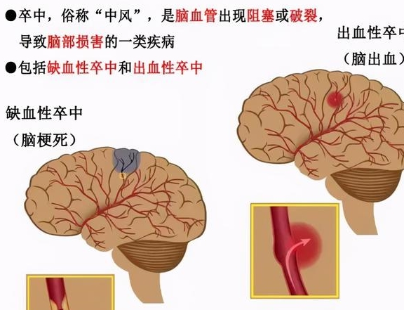 根据"中国卒中流行报告"显示:我国脑卒中,我们老百姓一般叫中风,脑
