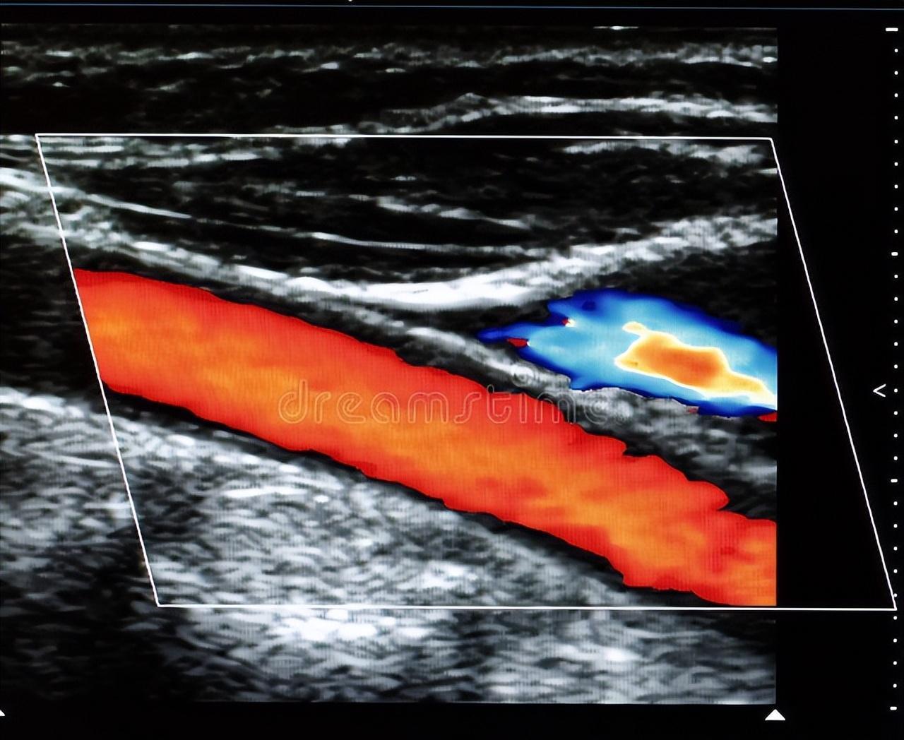 除了评估斑块的特征外,超声检查还可以评估其他参数,如血流速度,血管
