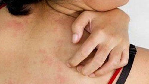 全身性的皮肤瘙痒.