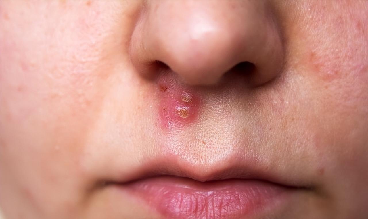 第五种就是可以用于疔疮肿毒的人群,这样的人常是因为心火旺盛引起