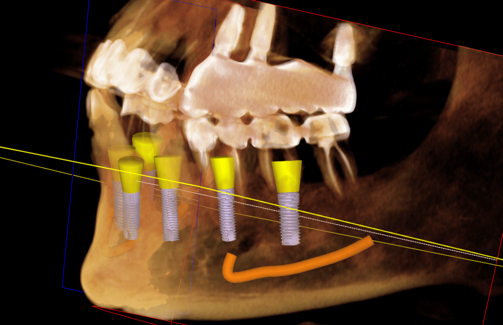 下颌6雕牙步骤图片