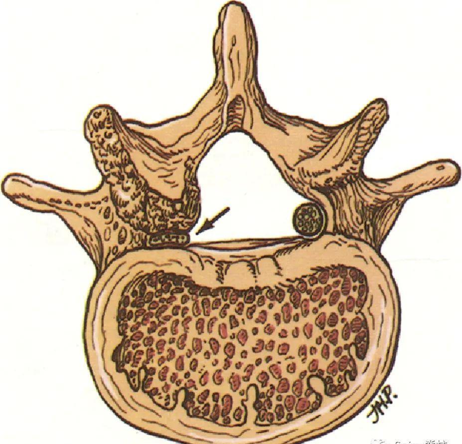 侧隐窝 (lateral recess)_zone_关节_区域
