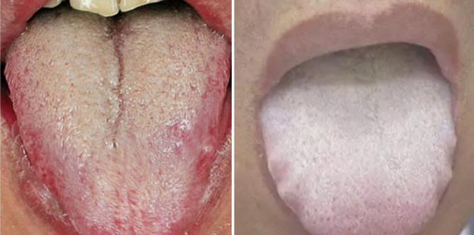 千古化痰第一方,化老痰,顽痰,顽痰一除,三焦畅通,一身轻松_崔医生