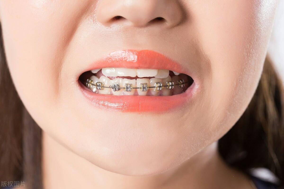 成年人千万不要矫正,正畸牙齿后遗症太可怕了