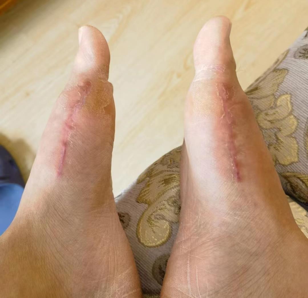 来自山东青岛的30岁帅哥分享:做拇外翻术后的恢复情况!