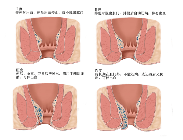 正常肛门痔疮图片