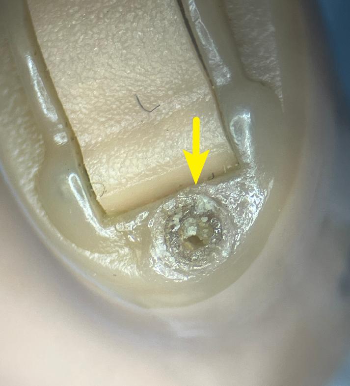 导致助听器声音减弱或没有声音具体案例见下图:定制机麦克风孔或耵聍