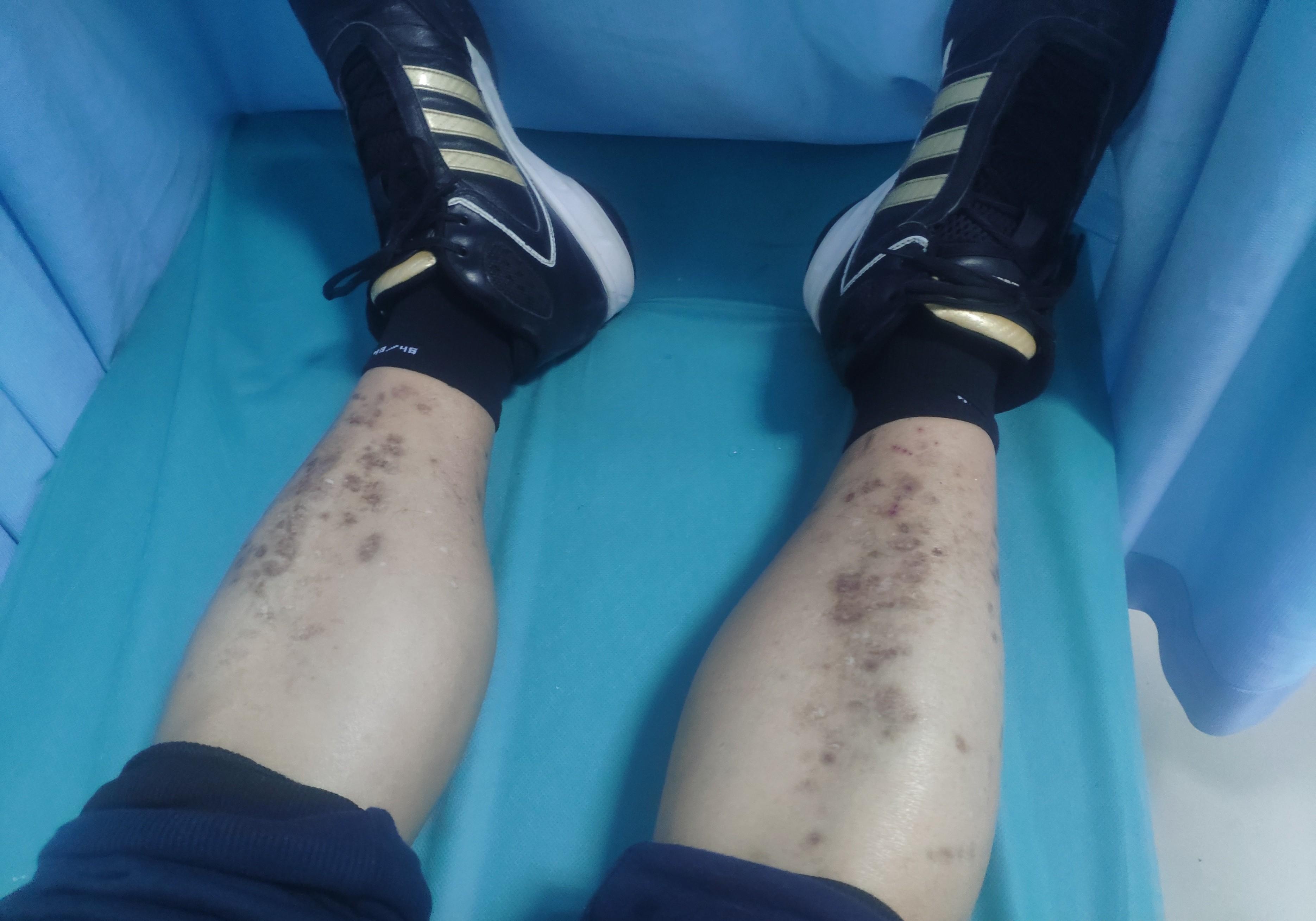 磕完了就好了,自打得了糖尿病以后磕完了就留个印"他的腿上的这个斑痕