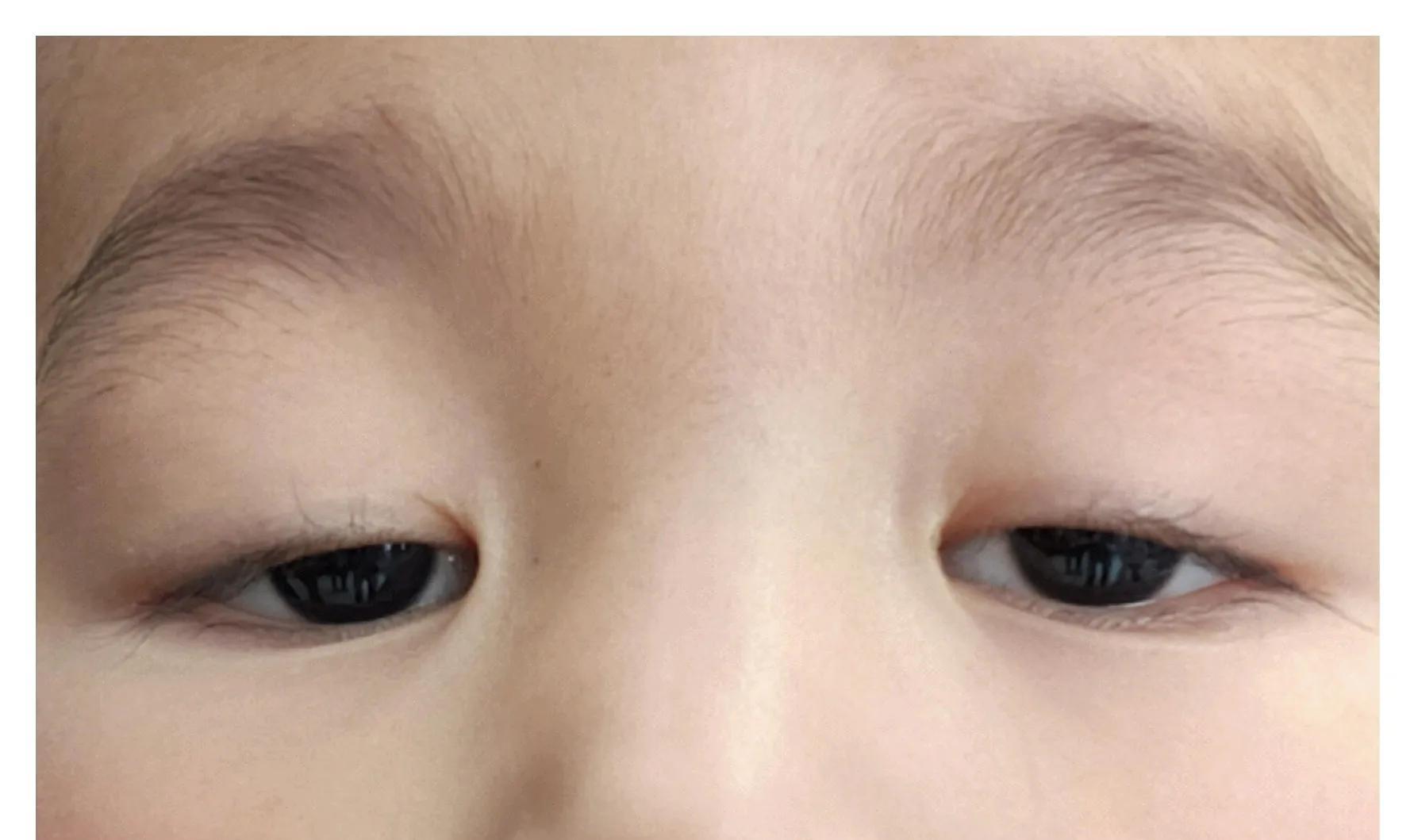 眼角下垂鼻梁,山根或耳朵上长青筋,眼下发青,都是肝气淤滞的表现.