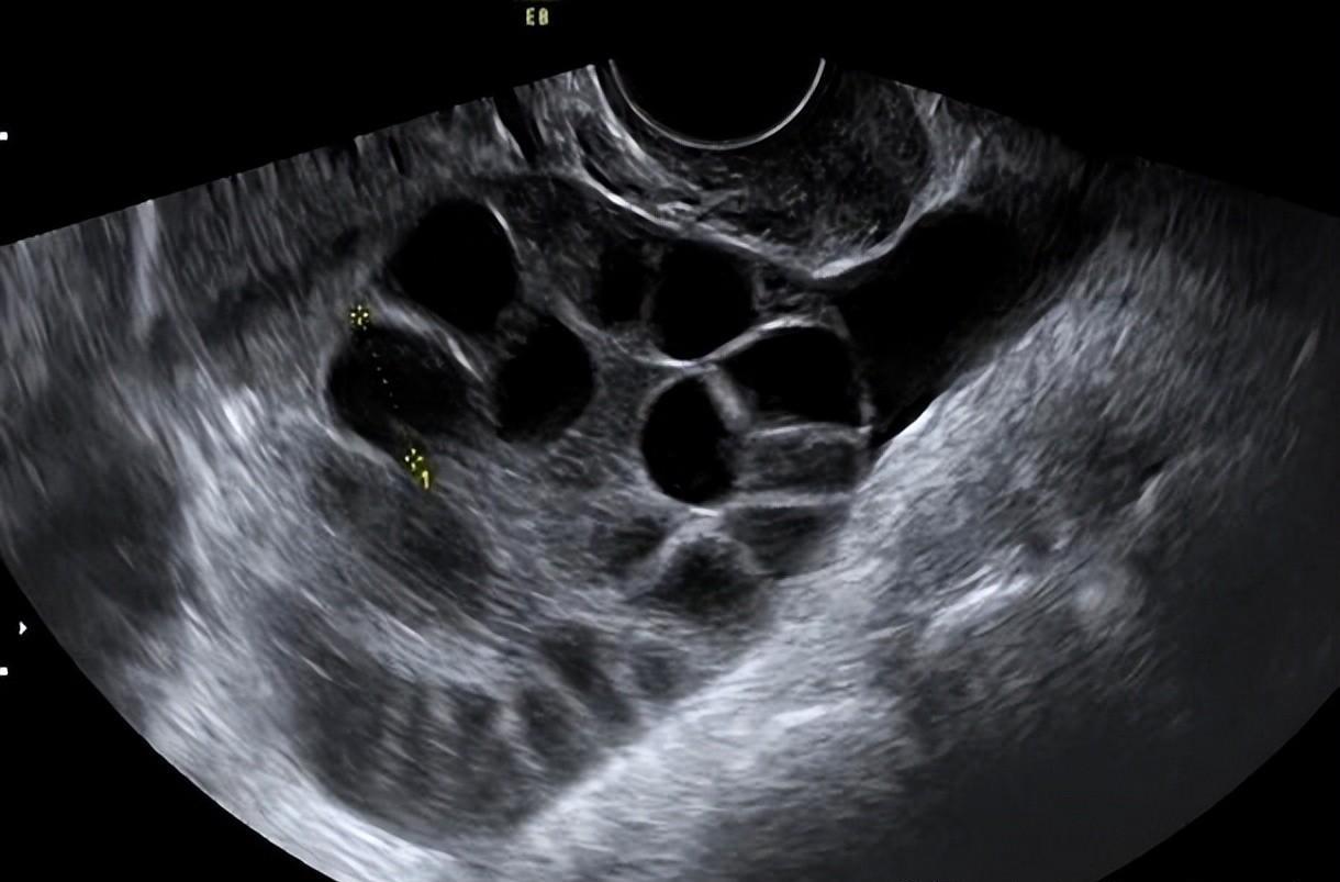 超声检查发现卵巢增大