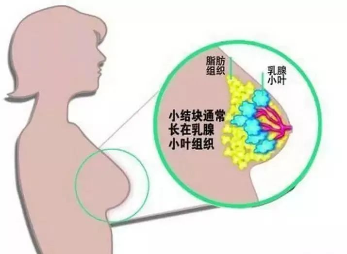 乳房包块正常图片