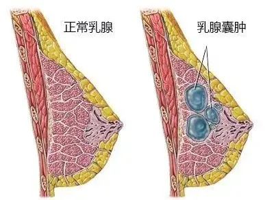 乳房肿块的5个常见原因,最后一个一定警惕了