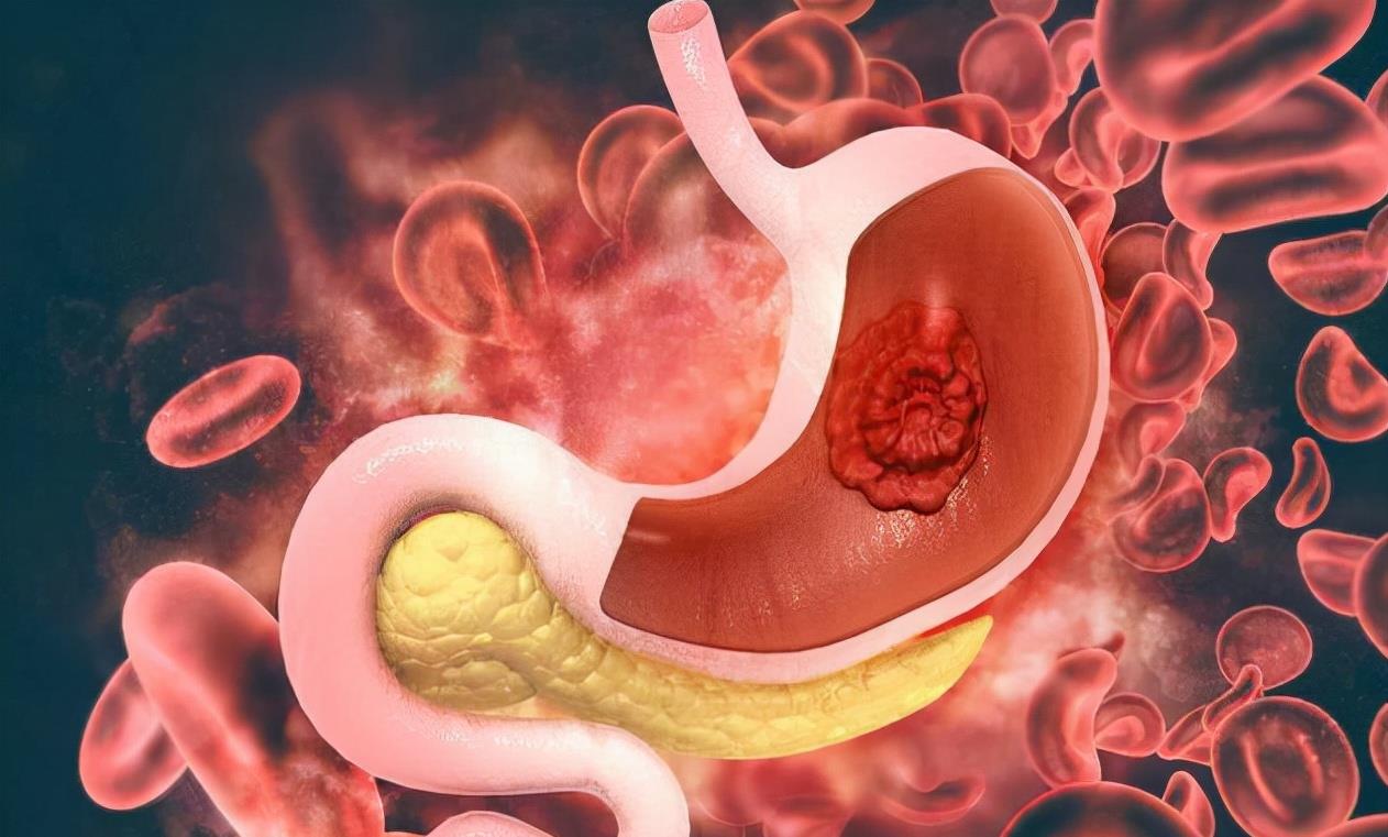 "1水"或比牛奶还伤胃,劝你少喝_胃部_肠胃_疾病