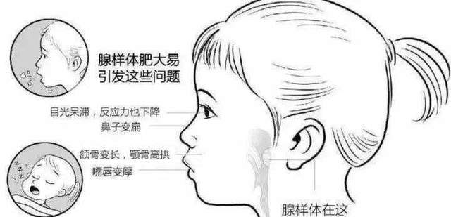 是指因腺样体肥大或张口呼吸而导致的不一样的面部特征,主要表现为