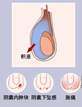 睾丸附睾炎是什么症状图片