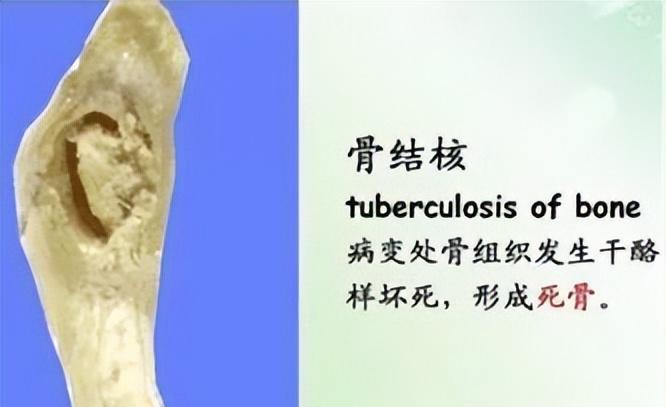 骨结核病知多少?本文告诉你