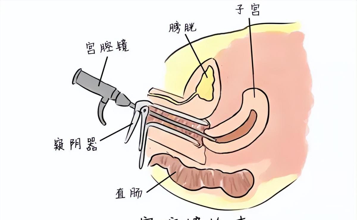 女孩检出两个阴道,还有双子宫?医生解答,详细告诉你怎么办!