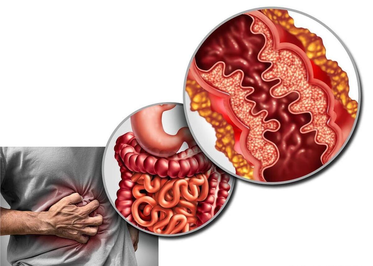 肠炎粘液和肠癌粘液图片