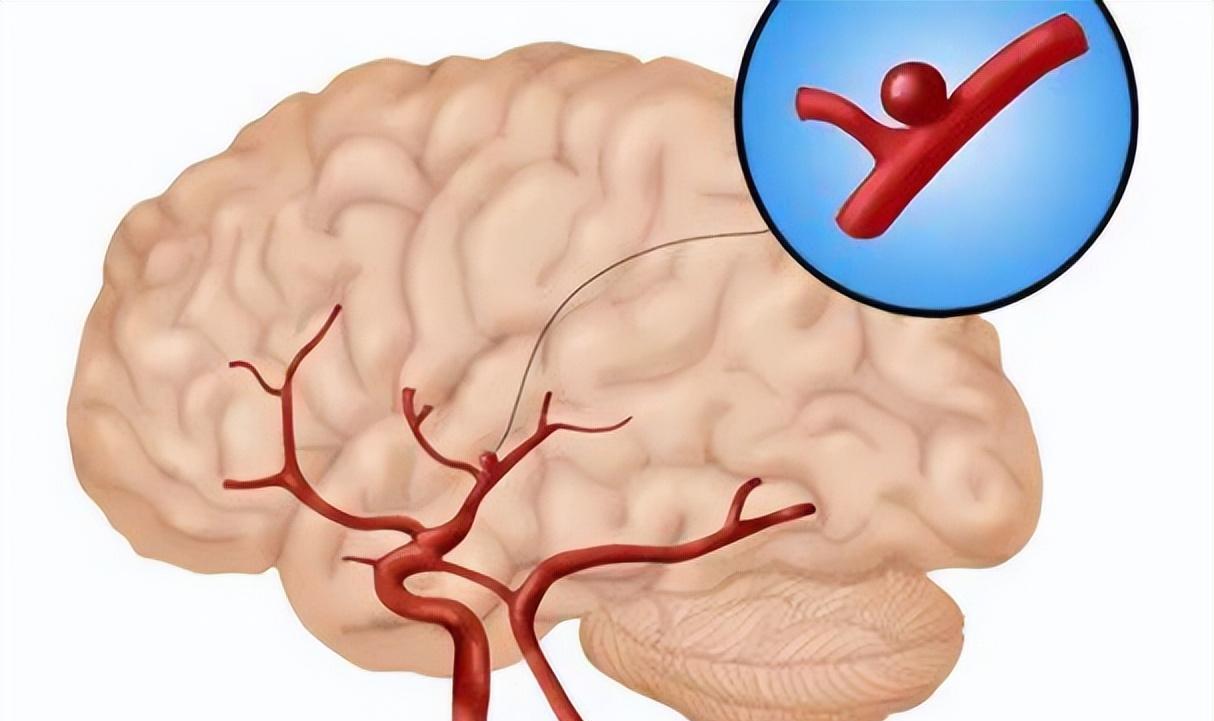 "蛛网膜下腔出血需要进行病因学检查,cta是临床中诊断颅内动脉瘤最
