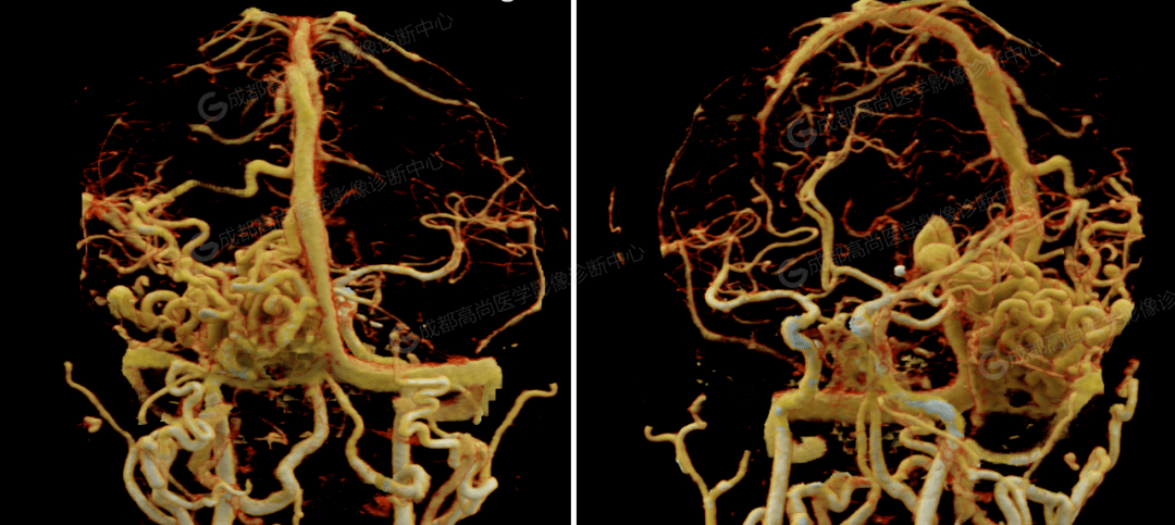 【高尚病例】头颅cta发现脑动静脉畸形1例【成都高尚医学】