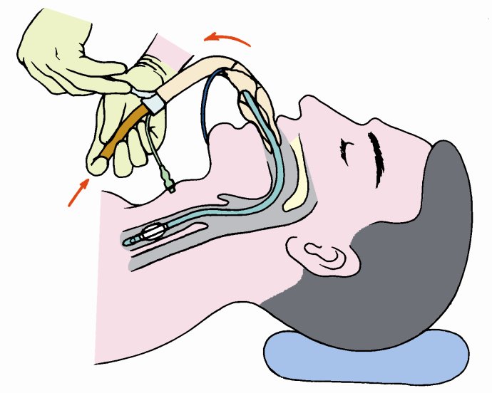喉咙插管呼吸图片图片