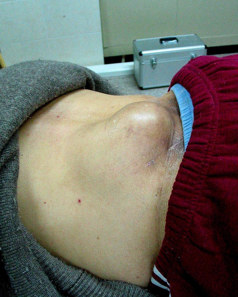 结节,囊肿,肌瘤,两位药泡水,消瘀散结,行气活血_淤血_三七_中药