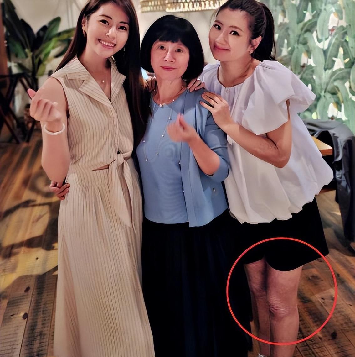但怀孕后心态更为平和坚定,大方晒腿部烧伤疤痕,看到任家萱的腿部伤痕