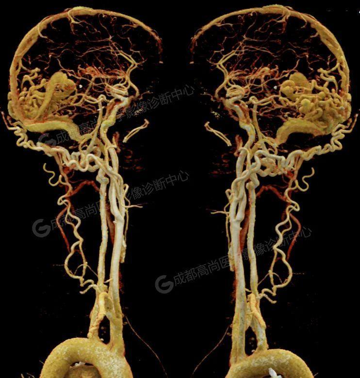 头颅cta诊断脑动静脉畸形1例_手术_血管_病变