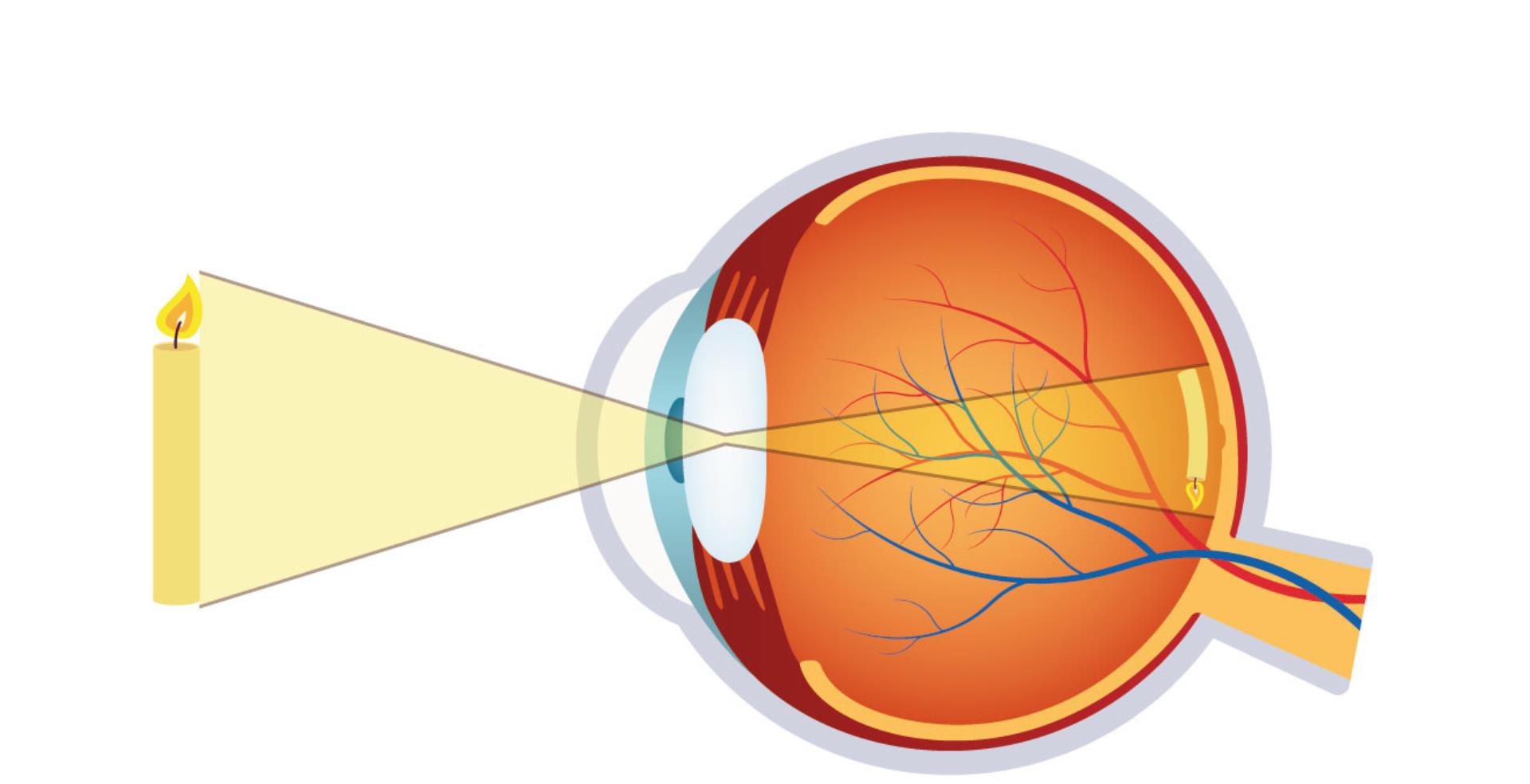 眼睛_治疗_晶状体