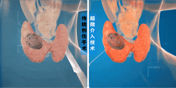 甲状腺结节手术恶性图片