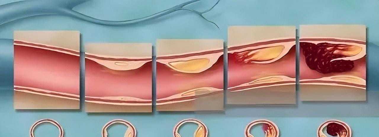 医生坦言:那些"逆转斑块"的人,都做到了一个关键_胆固醇_郭艺芳_血管