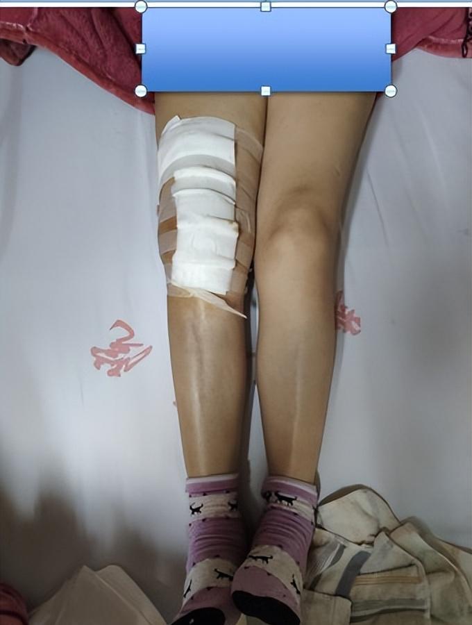 外八字(x型腿)膝关节炎的手术治疗――需要尽早手术吗?
