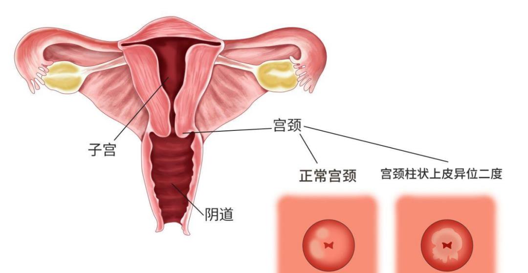 查出宫颈糜烂怎么办,会得宫颈癌吗?