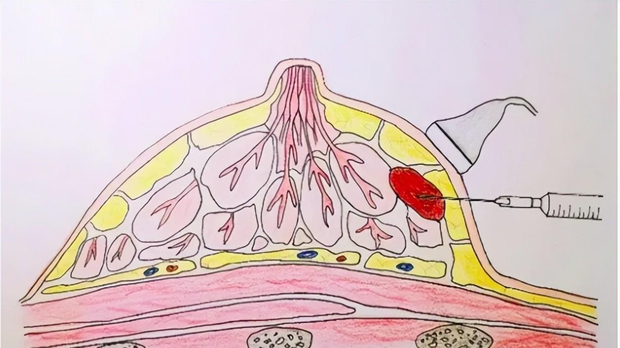 乳腺肿瘤穿刺活检会引起病细胞扩散吗?_患者_进行_诊断
