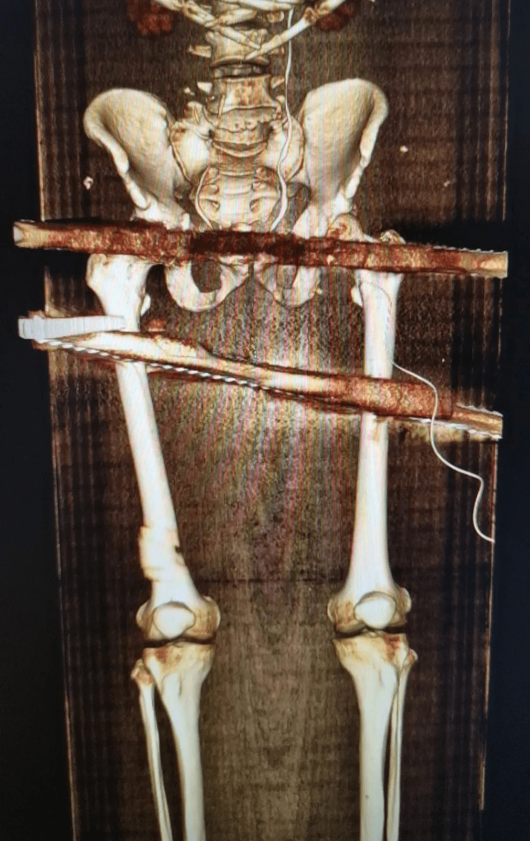 危急时刻:钢筋贯穿身体,7小时生死营救……_患者_手术_血管