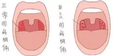 张嘴看到了会厌图图片