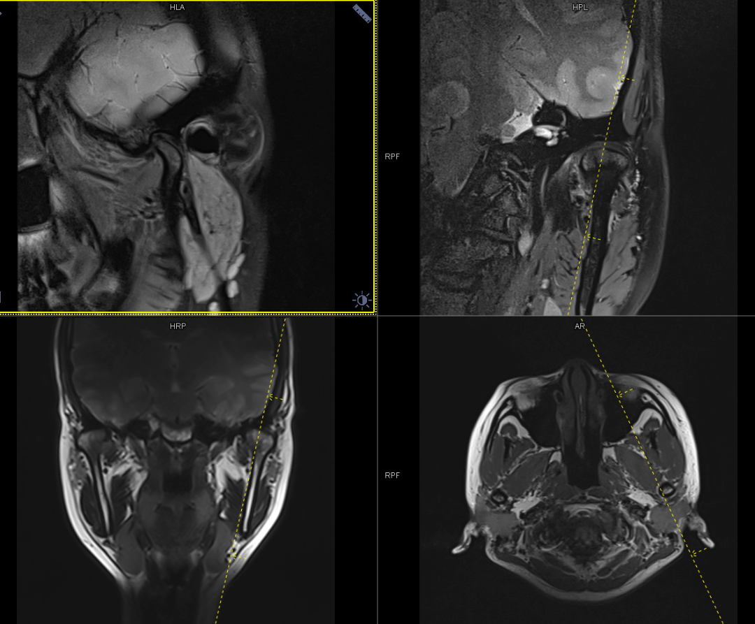 【高尚病例】颞下颌关节紊乱的磁共振检查_扫描_患者_软组织