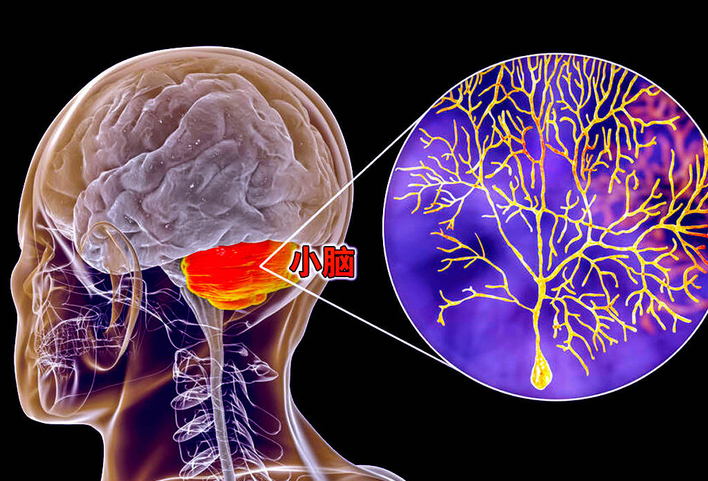 小脑萎缩,治疗就有希望_患者_身体_严重