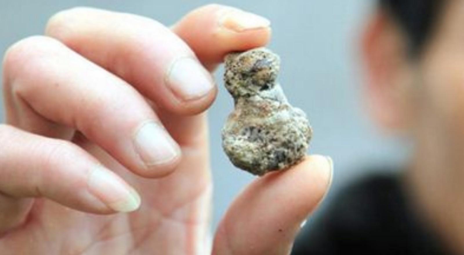 体外冲击波碎石联合内镜取石治疗慢性胰腺炎胰管结石有何优势?