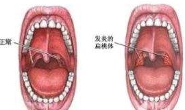 扁桃体发炎饮食选择_症状_炎症_食物