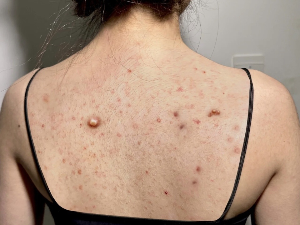 顽固痘痘已断根!过来人自信分享后背痘清除经验!立马拥有牛奶肌!