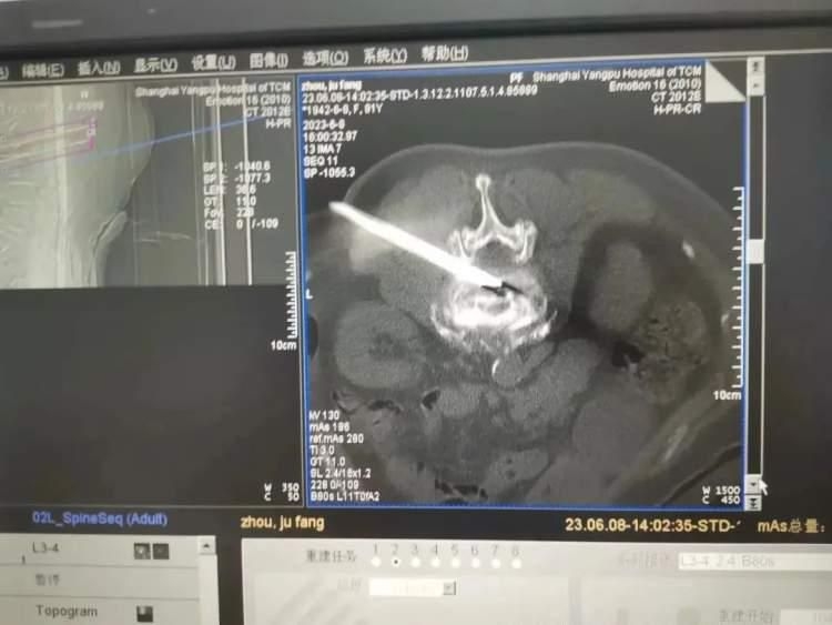多科联合手术，成功治疗严重腰椎间盘突出症-多节腰椎间盘突出手术