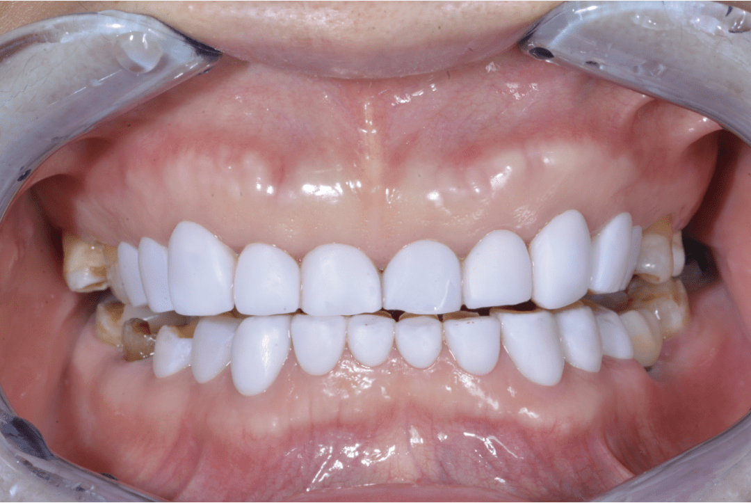 美容院的牙贴面,你真的敢做吗?_牙齿_口腔_机构