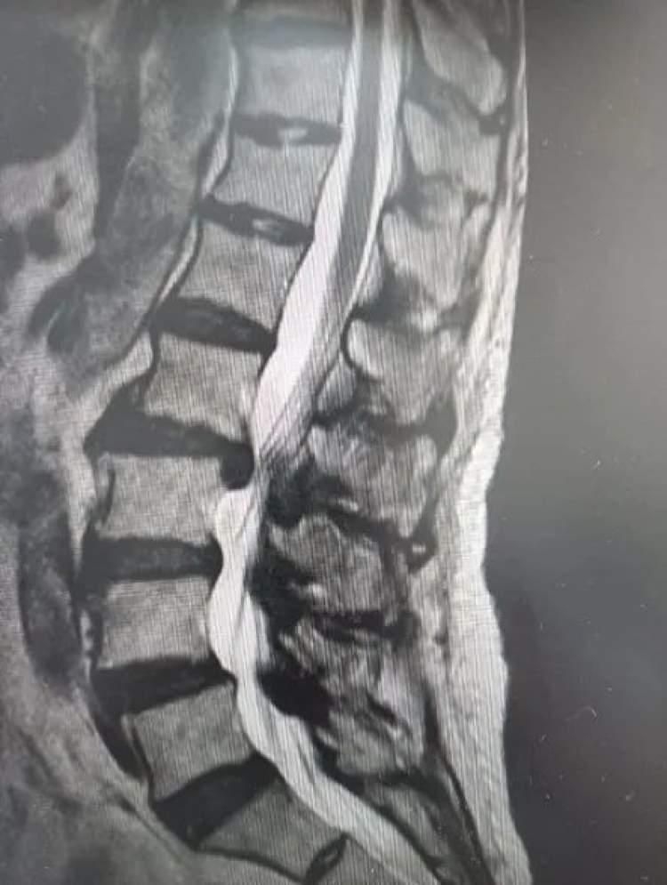 多科联合手术，成功治疗严重腰椎间盘突出症-多节腰椎间盘突出手术