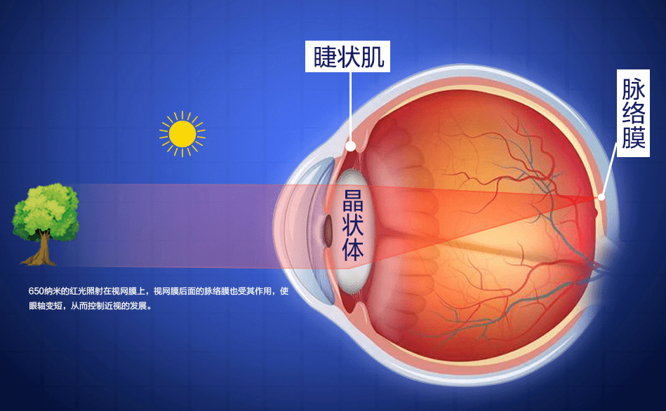 哺光仪治疗近视有用吗(附利弊)