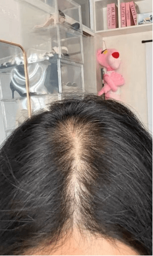 发缝宽头顶稀疏怎么办?育发生发的问题都交给育发液!