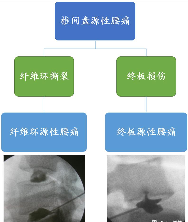 schmorl结节伴骨髓水肿(典型mri)_病变_纤维_造影