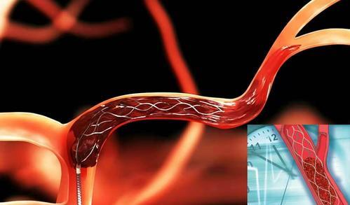 大血管闭塞的开通率不及30%,静脉溶栓与更好的预后有关?