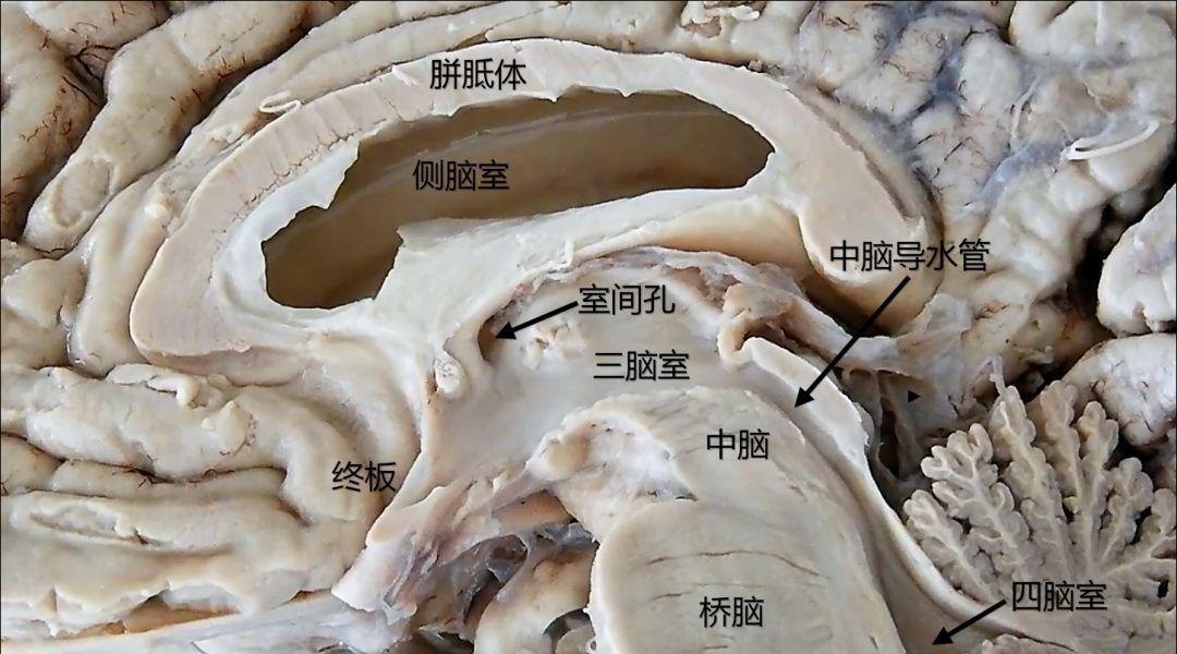 第三脑室第四脑室图片