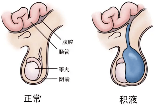 鞘膜积液和疝气是怎么造成的(附区别是什么)